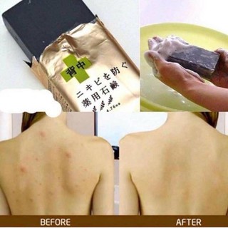 Xà bông xóa mụn lưng For Back