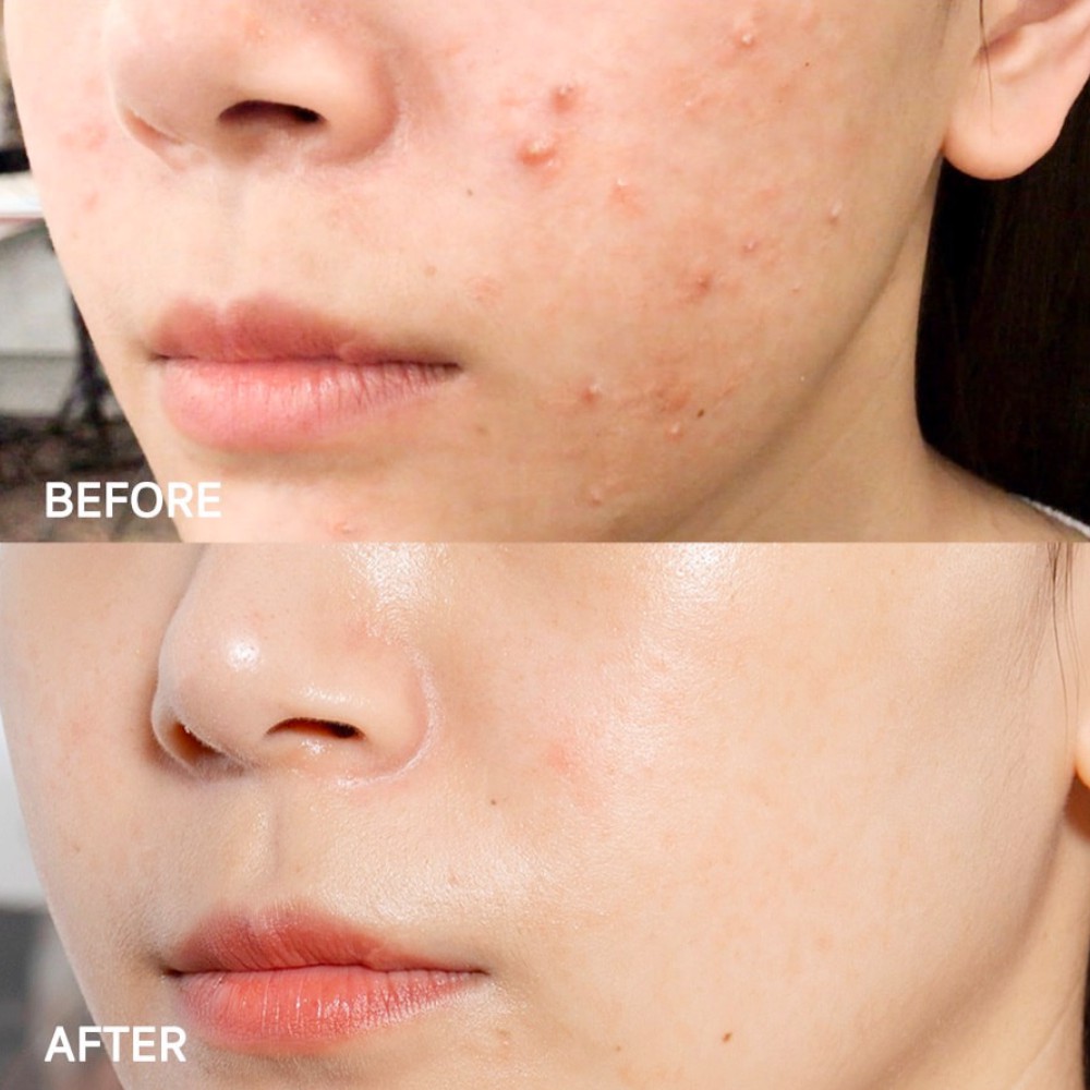 Tinh chất tràm trà giả mụn Serum Derladie Herbal Ampoule For Blemish