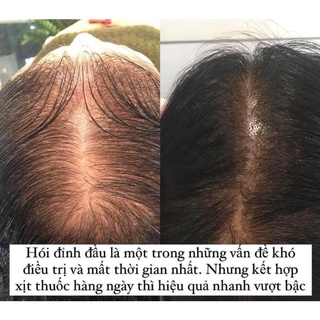 Xịt mọc tóc Minoxidil 2%