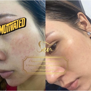 (COMBO GIÁ SỈ) TINH CHẤT - NẠ - SEN VIP - SERUM