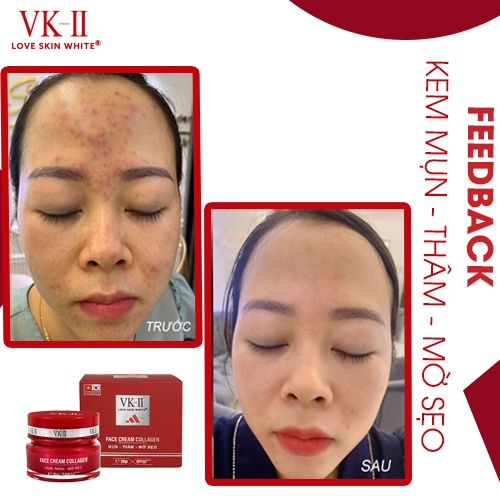 Kem dưỡng da giảm mụn mờ thâm sẹo VK-II Love Skin White Face Cream Collagen 20g