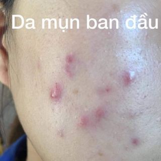 Kem mụn Spa Hàn