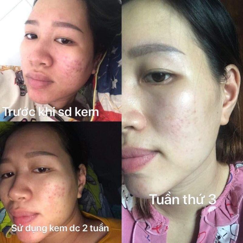 FACE MỤN 2C(mua 10tặng 1)