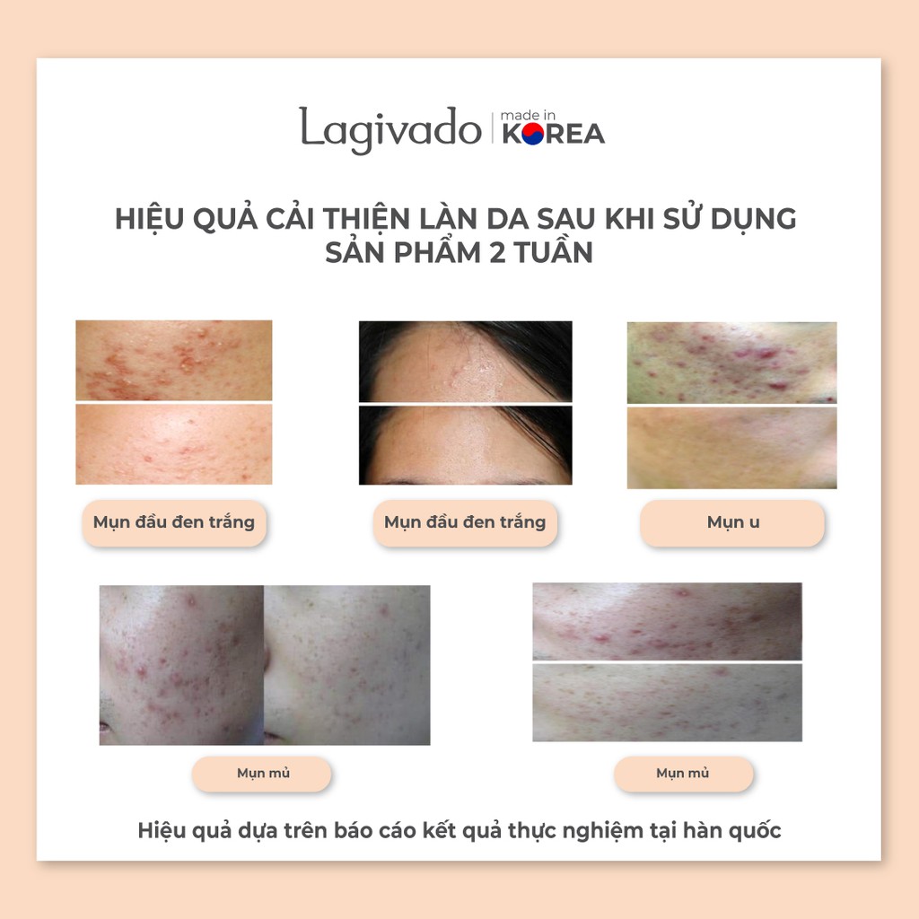 Kem giảm mụn, ngăn ngừa thâm sẹo và mụn tái phát Hàn Quốc Lagivado Dr. Atreat Cream 30 ml