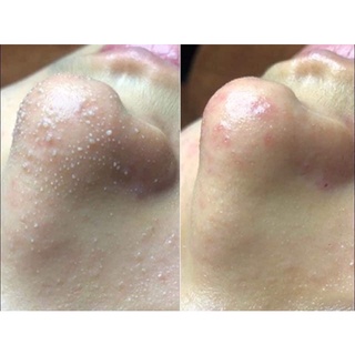 Ủ MỤN REMOVES BLACKHEADS