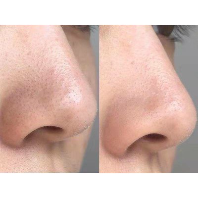 [CHÍNH HÃNG] Máy Làm Se Khít Lỗ Chân Lông, Loại Bỏ Mụn Đầu Đen, Mụn Ẩn, Làm Sạch Da, Hết Bụi Bẩn | BigBuy360 - bigbuy360.vn