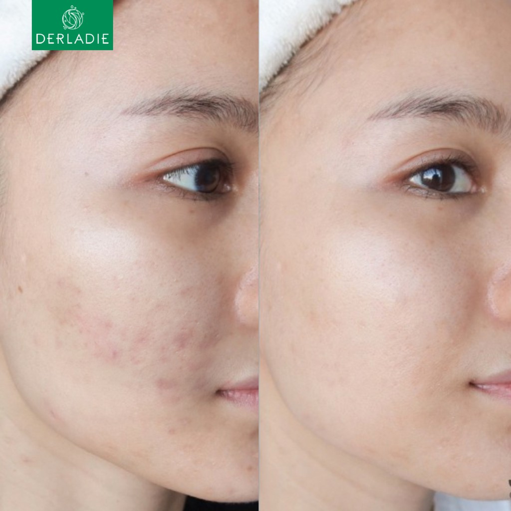 Siêu Tinh Chất Tràm Trà Giảm Mụn Sau 14 Ngày Derladie Herbal Ampoule For Blemish 30ml | BigBuy360 - bigbuy360.vn