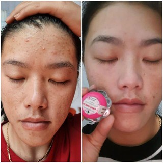 KEM MỤN ĐÔNG Y HOA ĐÀO