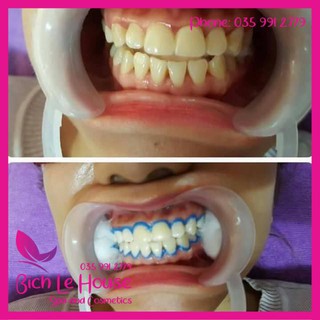 KEM BẢO VỆ NƯỚU DÙNG CHO TẨY TRẮNG RĂNG HÀNG CHÍNH HÃNG- Spa Bích Lê House