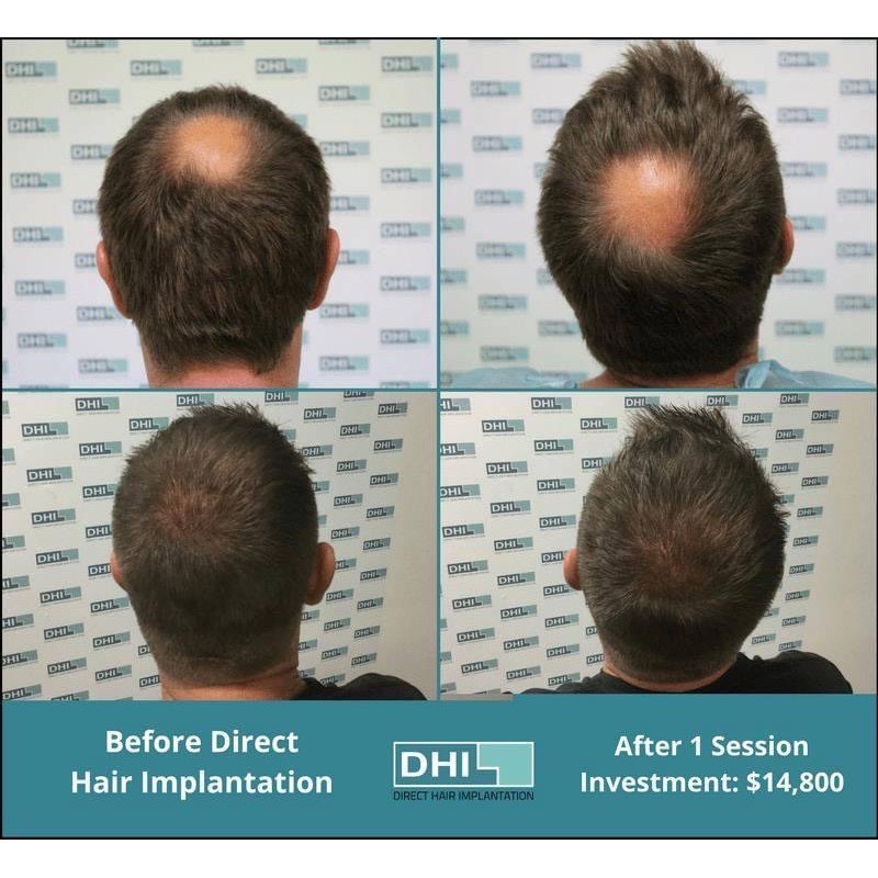 Hair Restore Advance - Viên uống chống rụng tóc, kích thích mọc tóc 60 viên_ (Hàng_chuẩn)