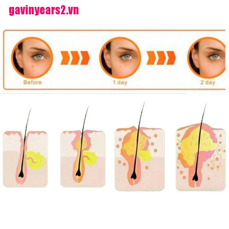 Bộ 36 Miếng Dán Hỗ trợ giảm mụn Hydrocolloid Gav2 Cải Thiện Tình Trạng Mụn