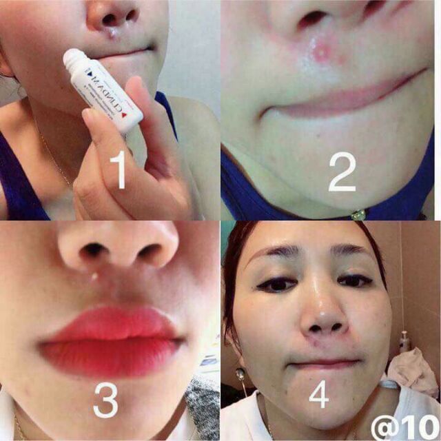 KEM CHẤM MỤN CLINDA | BigBuy360 - bigbuy360.vn