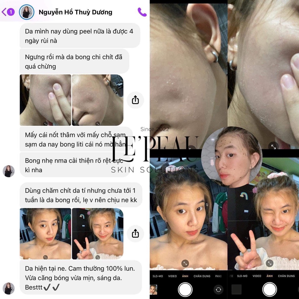 - Peel Da Vi Tảo Retinol Le'Peau Hoàng Thiên Sâm Tái Tạo Da 10ml 3-7 Ngày Xong Liệu Trình Bong da