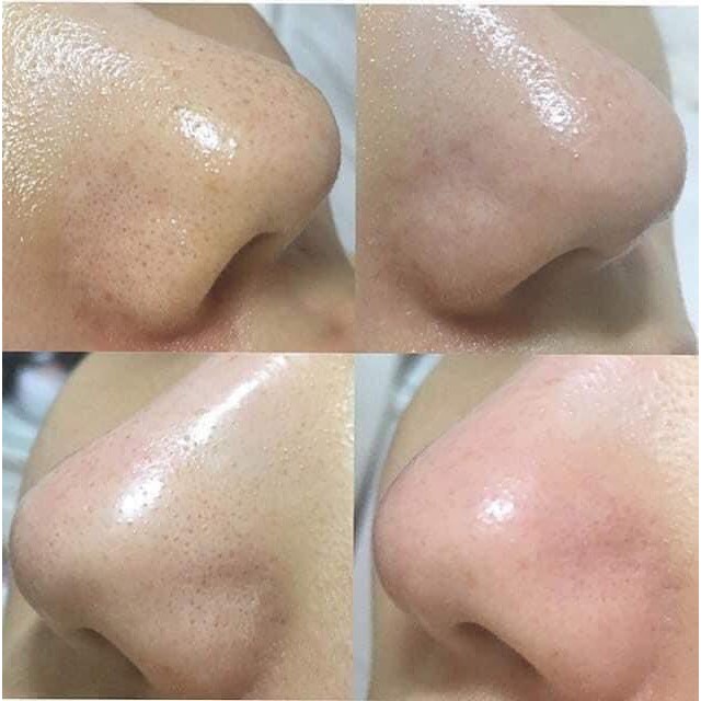 Dung dịch ủ mụn Medipeel 100ml