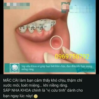 Sáp nha khoa 3M Unitek ( mỹ )
