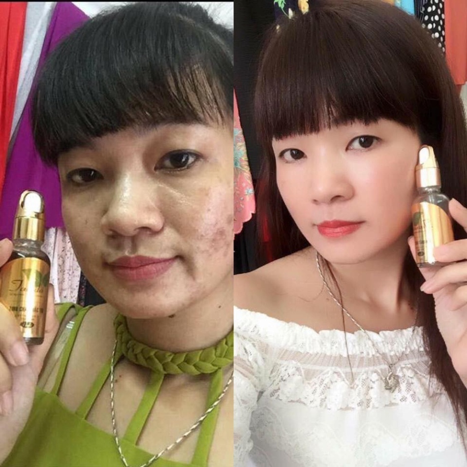 TINH CHẤT SERUM TAVIDA DÀNH CHO DA MỤN THÂM NÁM | BigBuy360 - bigbuy360.vn