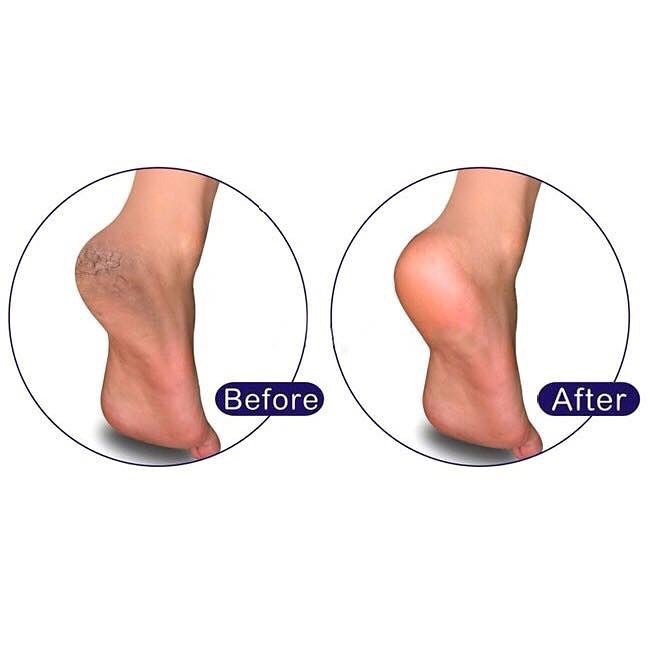 Vacosi Dụng cụ Chà gót chân Foot Peeling