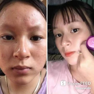 combo 5 hộp face mụn( mua 10hộp tặng 1 hộp)