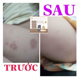 SERUM MỜ THÂM ĐA NĂNG PHÚC MINH TÂM [Hàng Chính Hãng Được Bảo Hộ] | Thế Giới Skin Care