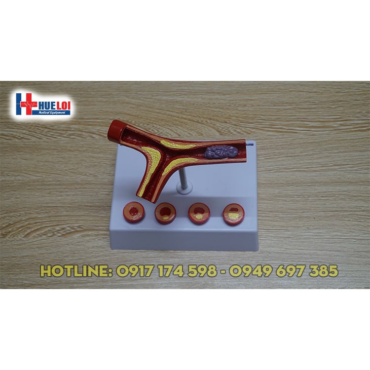 Mô hình huyết khối kèm  xơ vữa động mạch vành