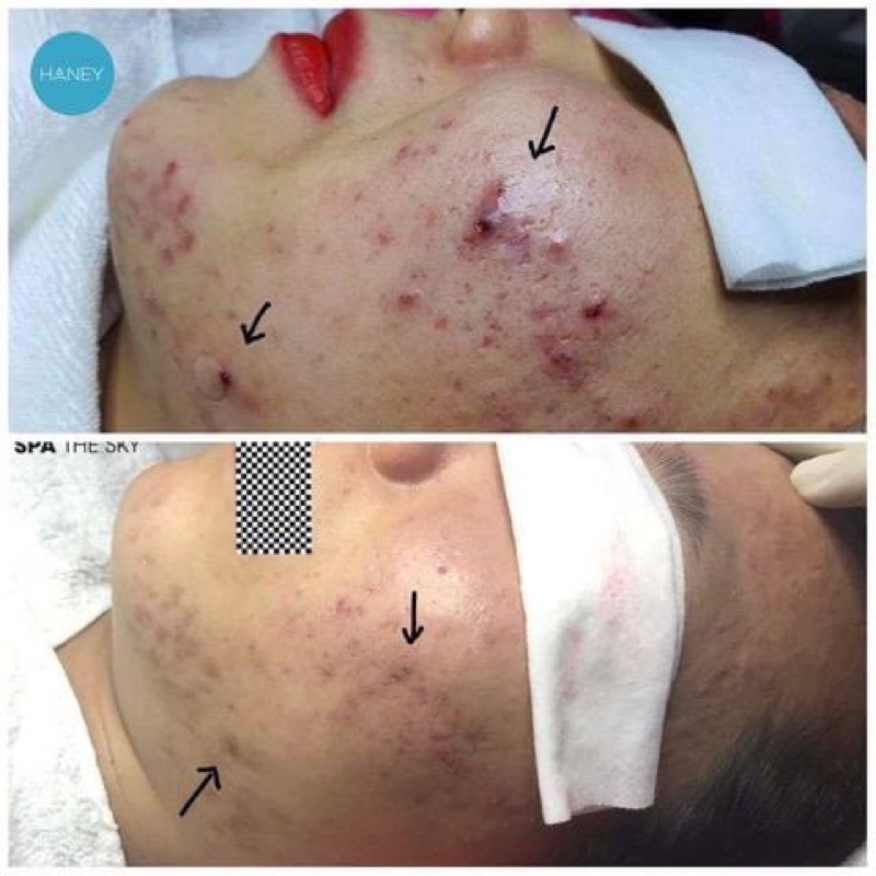 [NHẬP KHẨU] Bộ sạch sâu căng bóng CO2 Carboxy Sound Ribeskin Hàn Quốc