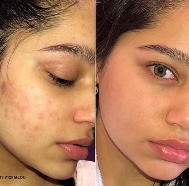 [THE ORDINARY] Tinh chất dầu dưỡng 100% Organic Cold-Pressed Rose Hip Seed Oil | BigBuy360 - bigbuy360.vn