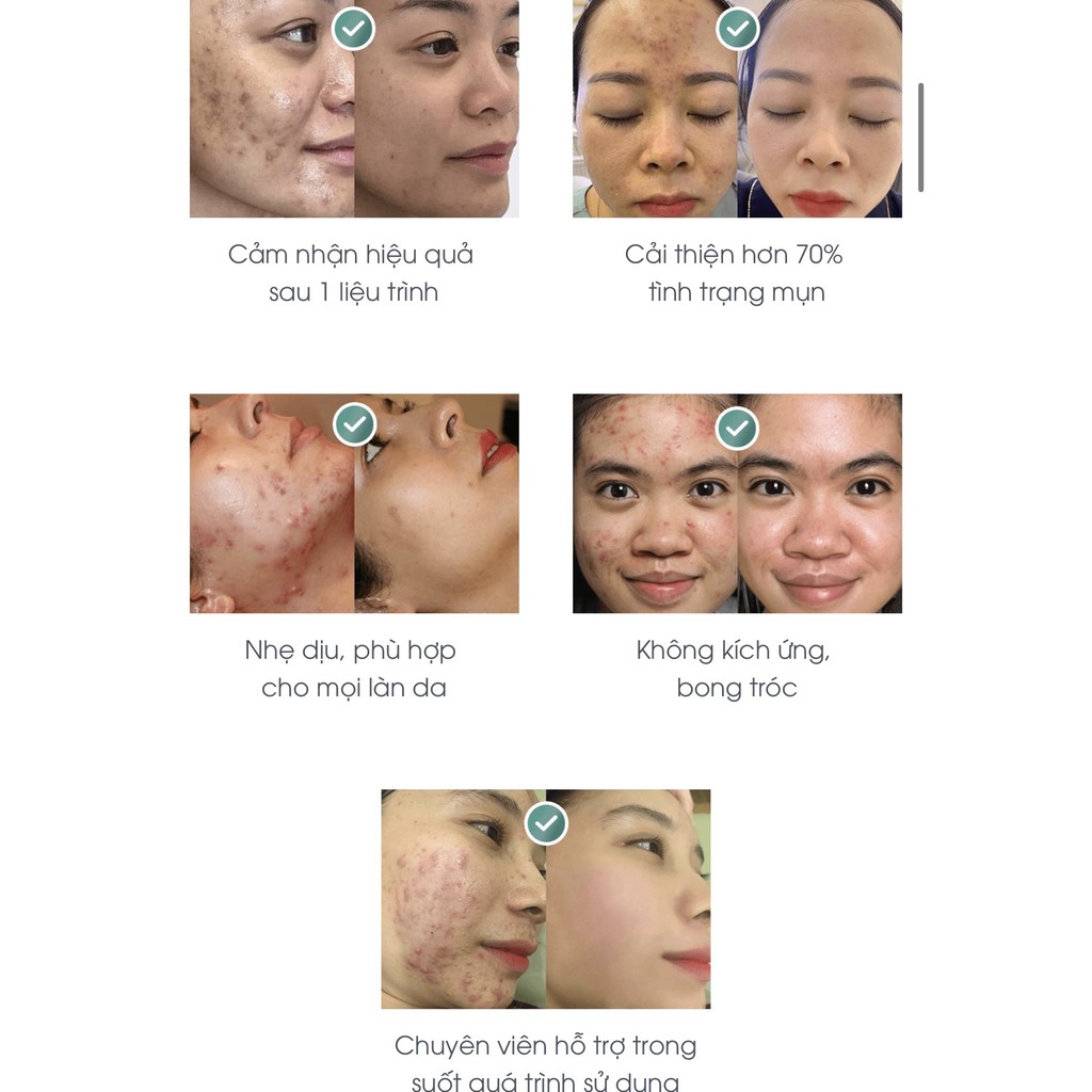 Serum cho da mụn thâm DETOX BLANC - Peel Acnes Blanc mẫu H Serum - Dưỡng Trắng Da 30ml | BigBuy360 - bigbuy360.vn