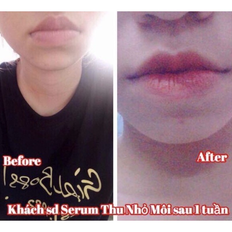Tinh chất thu nhỏ môi Miracle - Pháp, hiệu quả chỉ sau 14 ngày