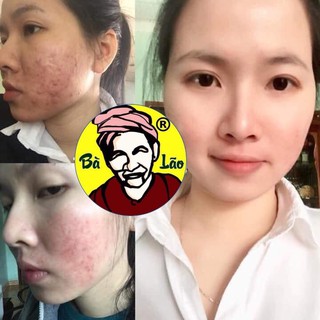 Sạch Mụn Cao Cấp Bà Lão - Sạch Mụn Liền Da