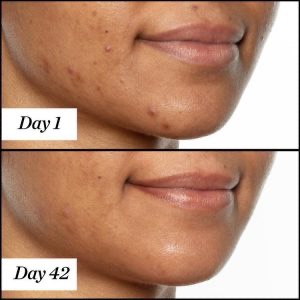 Dầu dưỡng da giúp làm giảm mụn Sunday Riley U.F.O Ultra Clarifying Face oil 35ml