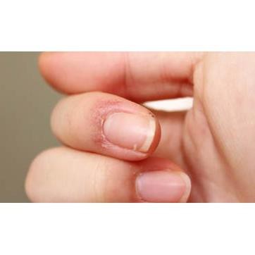 GEL BÔI LIỀN VẾT THƯƠNG SAKUMA NHẬT BẢN, GIÚP MAU LÀNH DA KHI BỊ XƯỚC TAY HAY ĐỨT TAY