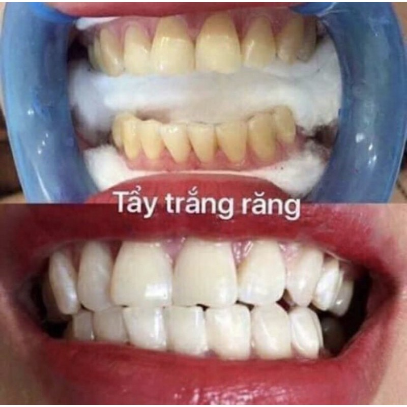 Thuốc Tẩy Trắng Răng