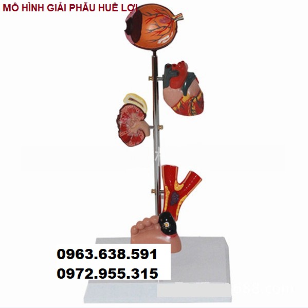 MÔ HÌNH TỔN THƯƠNG 5 CƠ QUAN ĐÍCH CỦA BỆNH TIỂU ĐƯỜNG