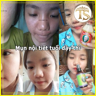 (っ◔◡◔)っ ♥ TINH CHẤT ♥ HẾT MỤN NÁM BHD