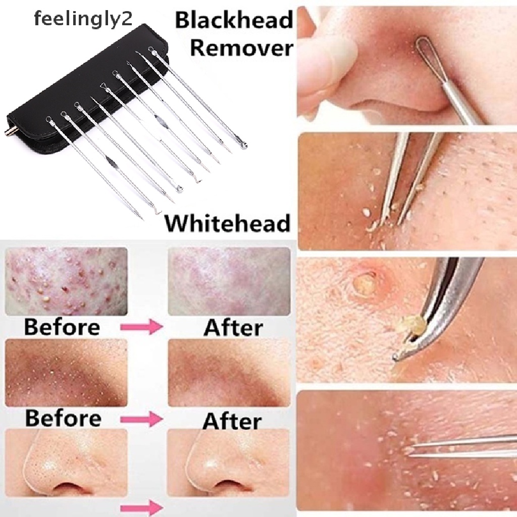 [Hàng mới về] Set 9 dụng cụ nặn mụn đầu đen mụn trứng cá bằng thép không gỉ tiện lợi