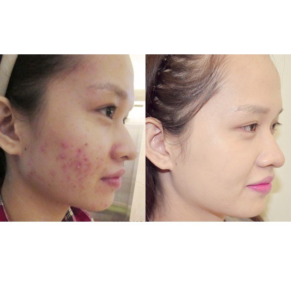 Kem mụn Acne Cream IRC mụn cám, mụn ẩn tăng sinh collagen phục hồi da mụn 10g | BigBuy360 - bigbuy360.vn