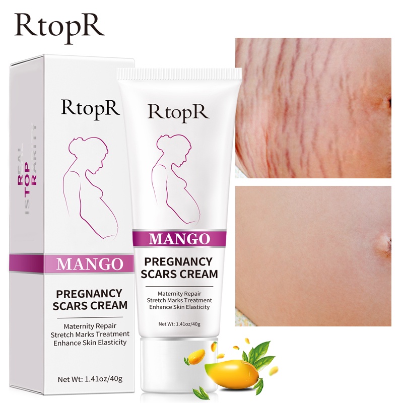 Kem Rtopr Cho Phụ Nữ Mang Thai Hỗ Trợ Giảm Sẹo Rạn Da Chống Lão Hóa Và Nếp Nhăn 40g