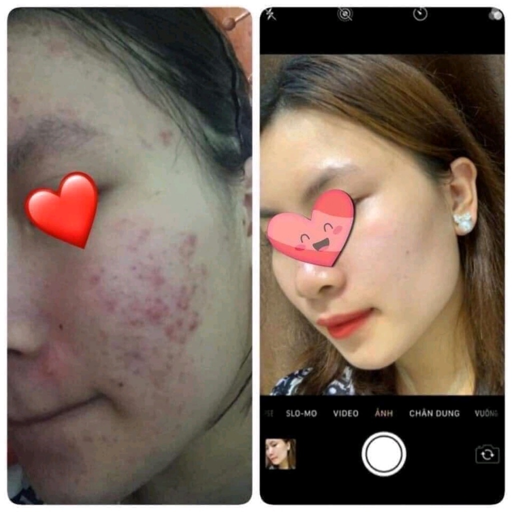 Cao Lá Nam 100% nhà nấu - không gây sưng đỏ, không bong tróc, ĐÁNH BAY MỤN và DƯỠNG DA ĐỀU MÀU hiệu quả