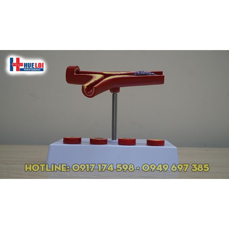 Mô hình huyết khối kèm  xơ vữa động mạch vành