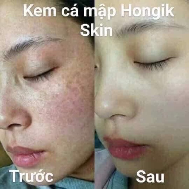 KEM NÁM   CÁ MẬP HONGISKIN NHẬP KHẨU HÀN QUỐC