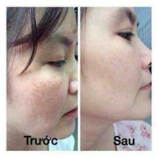 Mặt nạ ngủ mask botox