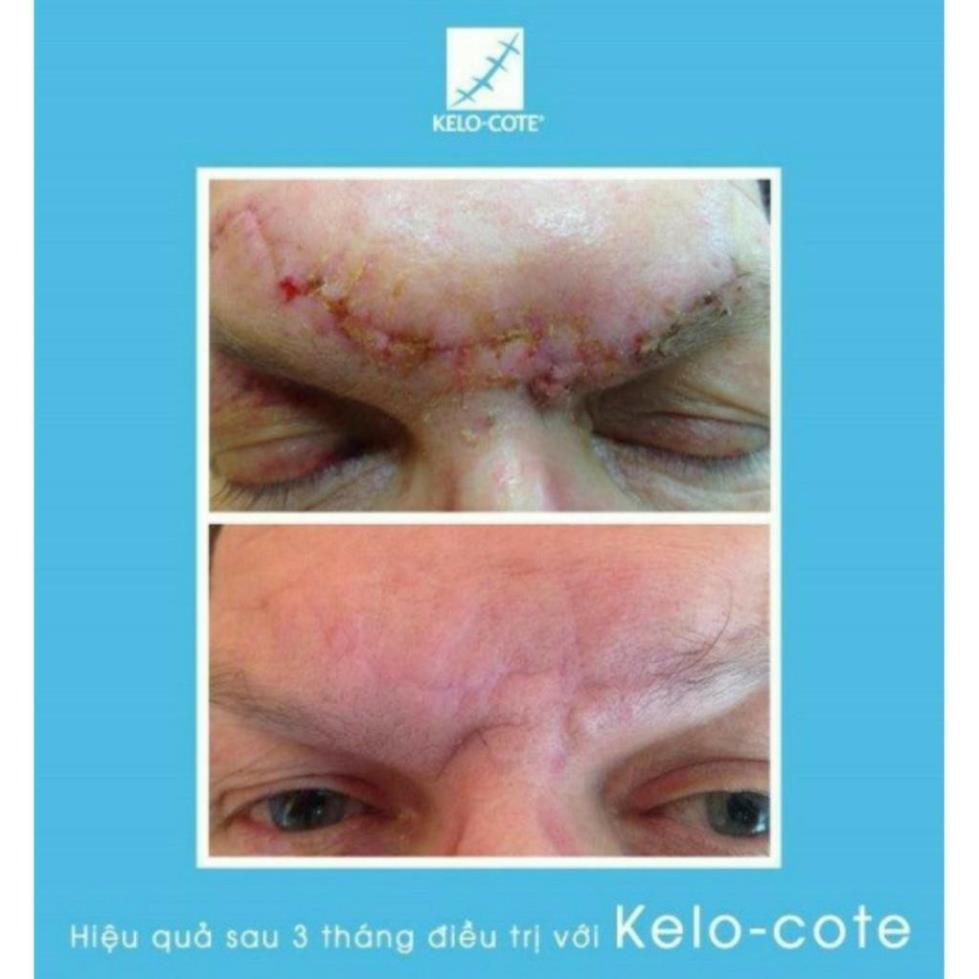 Kem Hỗ Trợ Giảm sẹo Kelo Cote hiệu quả chất lượng cao 15g