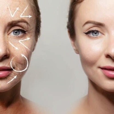 Viên uống cấp nước căng bóng da Superdiet acid hyaluronique vitamine c  150 viên của Pháp