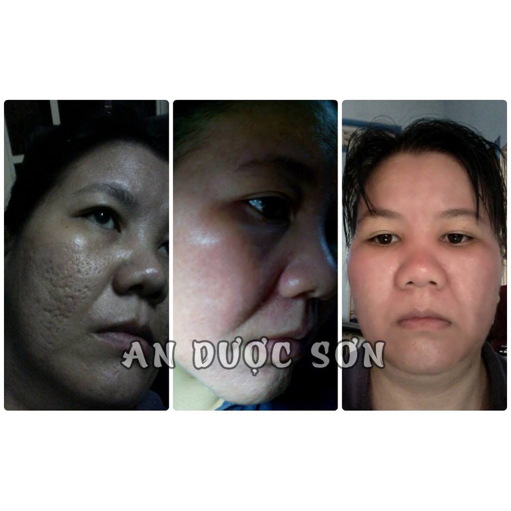 Serum tái tạo bong da An Dược Sơn 50ml