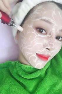 Phấn cấy mesowhite