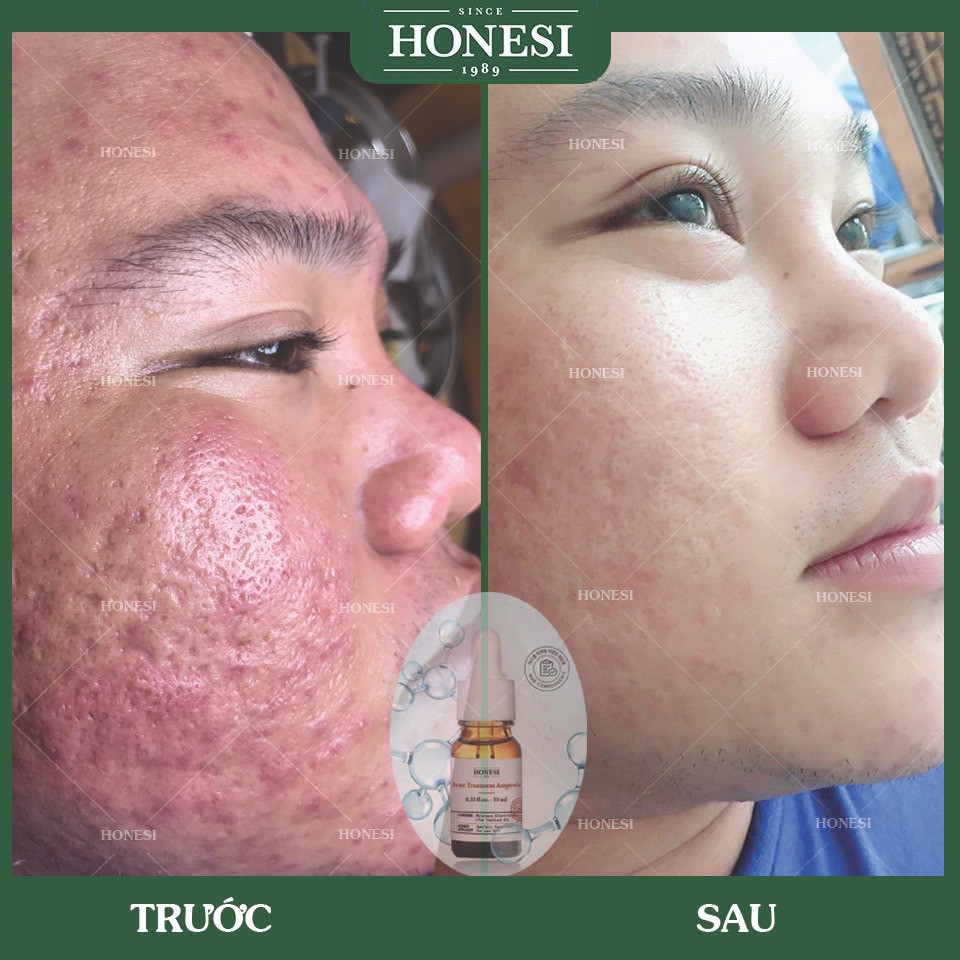 Sét Serum Giảm Mụn Nhanh Lành Tính HONESI Acne Treatment Ampoule (10ml x 5 lọ) - Hàn Quốc BONGSHOPAUTHENTIC | BigBuy360 - bigbuy360.vn