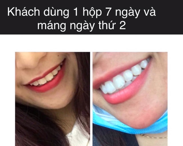 Miếng dán trắng răng Crest _ 1 Hour cấp tốc
