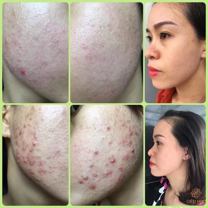 Bột rửa mặt OGANA cho da mụn