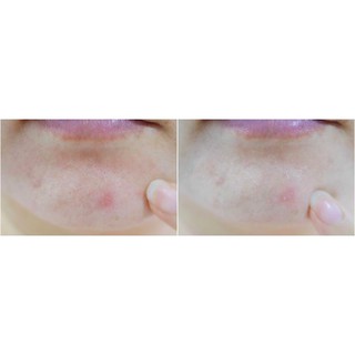 Mặt Nạ Dưỡng Da Trị Mụn Từ Rau Má Benton Goodbye Redness Centella Mask Pack