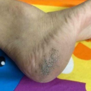 KEM TRỊ NỨT GÓT CHÂN CHUỐI